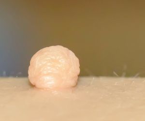 درمان زگیل تناسلی,درمان زگیل تناسلی آقایان,درمان زگیل تناسلی با لیزر